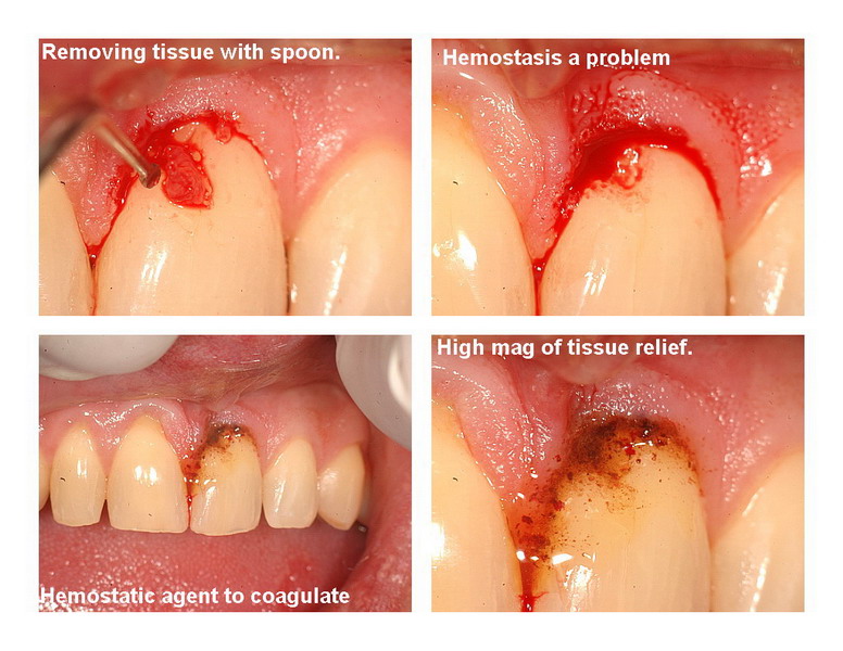 Frenectomy Pg 2 edited_resize.jpg